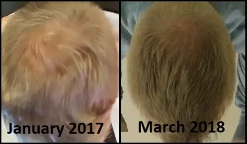 Hair loss before and after